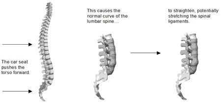 Low back pain after whiplash
